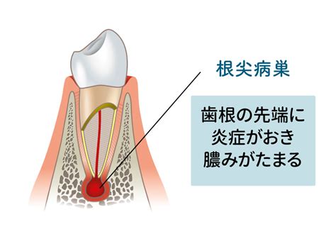 病巢 意味|【病巣 】とはどういう意味ですか？